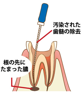 歯の根の外科治療